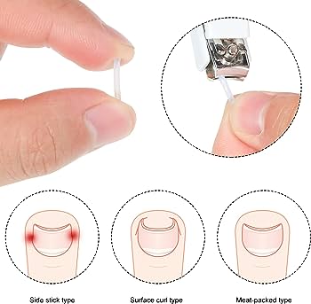 Ingrown Toenail Correction Tool