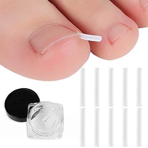 Ingrown Toenail Correction Tool